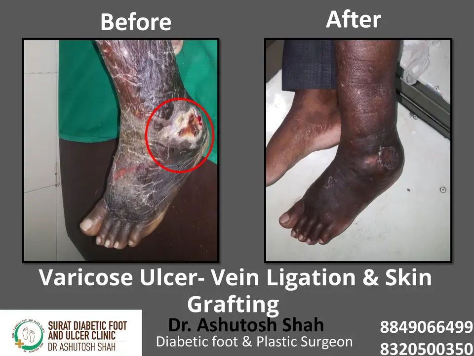 Varicose veins and Ulcers.pptx-7.webp